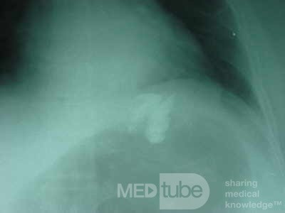 Large Gastric Varices (24 of 25)