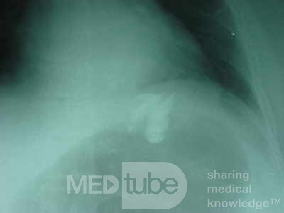 Large Gastric Varices (24 of 25)