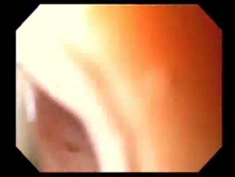 Severe Epistaxis - Case Study  (4 of 8)