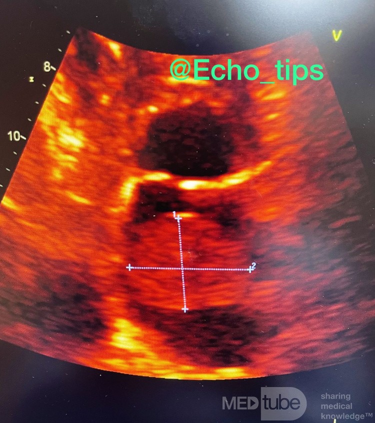 Left Atrial Myxoma