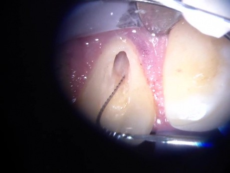 What Would You Do To Find This Endodontic Canal?