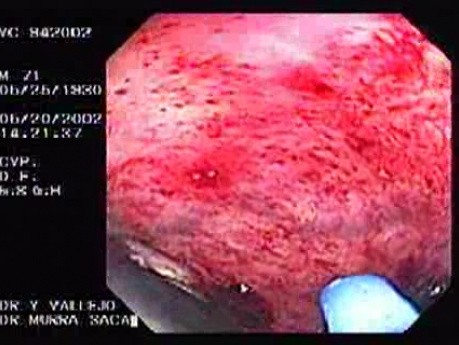 Radiation Proctosigmoiditis (9 of 14)