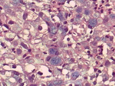 Gastric Cancer (15 of 15)