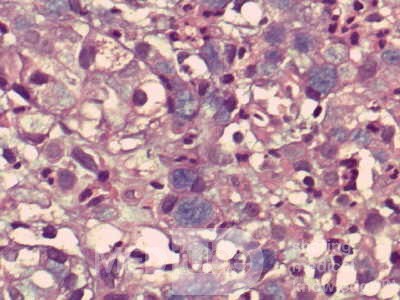 Gastric Cancer (15 of 15)