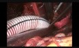 How To Cannulate for ECMO