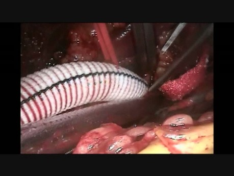 How To Cannulate for ECMO