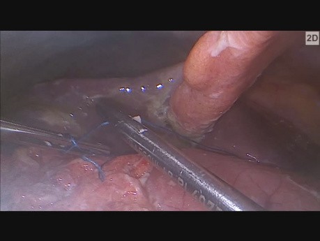 Laparoscopic Delivery of Perforated Pyloric Ulcer