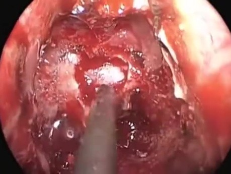 Exposed Carotid Artery at Bony Sella Opening