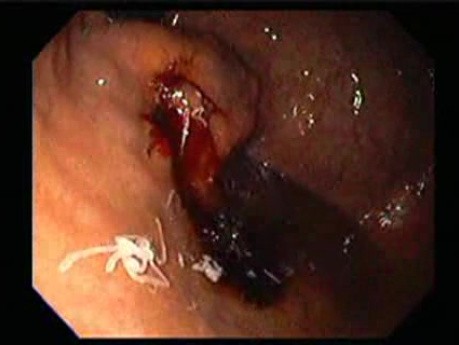 Gastric Varices - Endoscopic Ablation With Cyanoacrylate Glue (11 of 18)