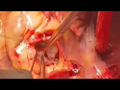 Patient with Single Leaflet Aorta and Single Coronary Artery