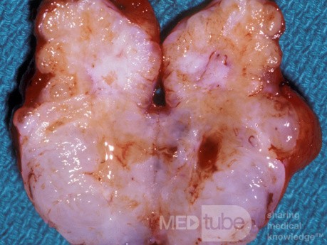 Mixed Tumor Parotid Gland Sectioned