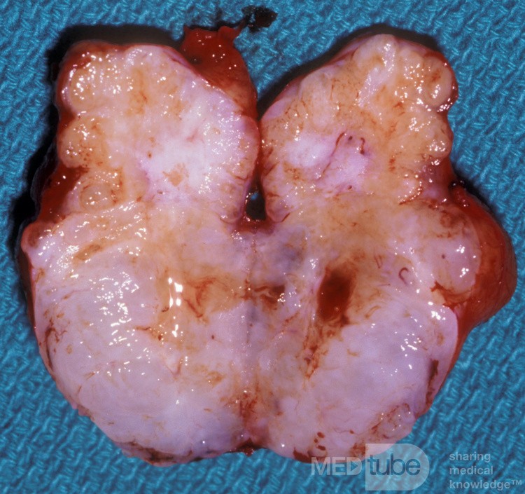 Mixed Tumor Parotid Gland Sectioned