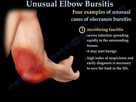 Unusual Bursitis of the Elbow - Video Lecture
