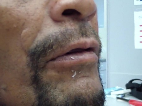 Maxillary Occlusal Rim Tryin - Speech - What To Look For.