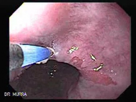 Barrett's Esophagus of long segment -Argon Plasma Coagulation (5 of 11)