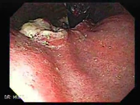 Esophageal Squamous Cell Carcinoma (3 of 5)