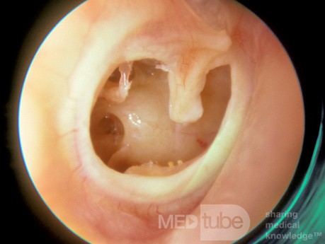 Subtotal Perforation Right Ear