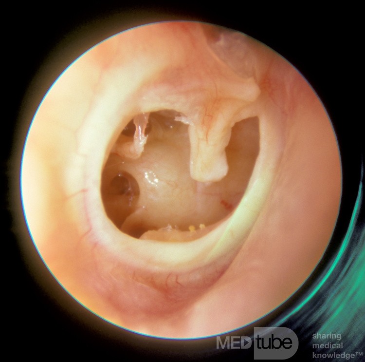 Subtotal Perforation Right Ear