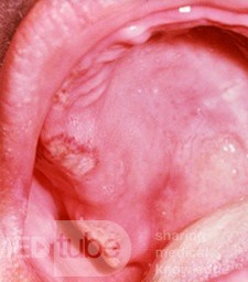 Behcet's Syndrome
