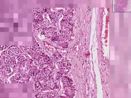 Sertoli cell tumor