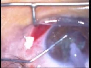 Phacoemulsification - Vertical Chopping