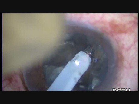 Black Crystalline Cataract