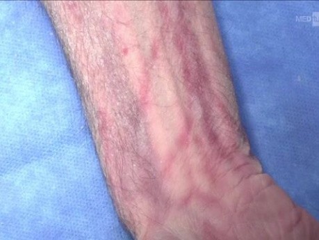 OrthoApproach - Volar (Henry) Approach to Distal Radius | Surgical Demonstration