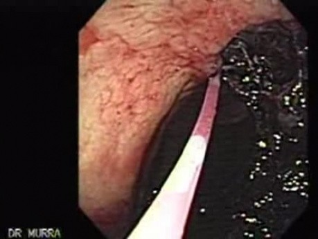 Gastric Cancer - Sclerotherapy, Part 1