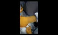 Total Glossectomy