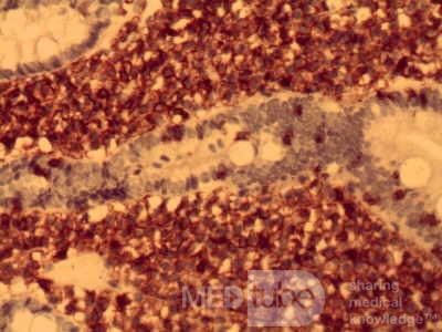 Gastric lymphoma with metastases to the duodenum (12 of 15)