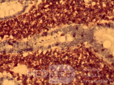 Gastric lymphoma with metastases to the duodenum (12 of 15)