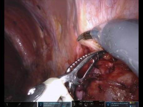 Resection of Thoracic and Mediastinal Diaphragmatic Endometriosis with Suture Closure