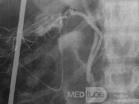 Low Junction of the Cystic Duct #2