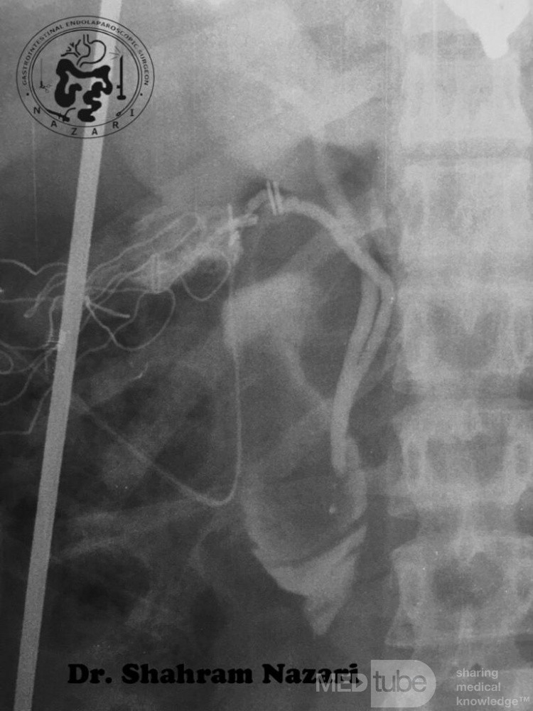 Low Junction of the Cystic Duct #2