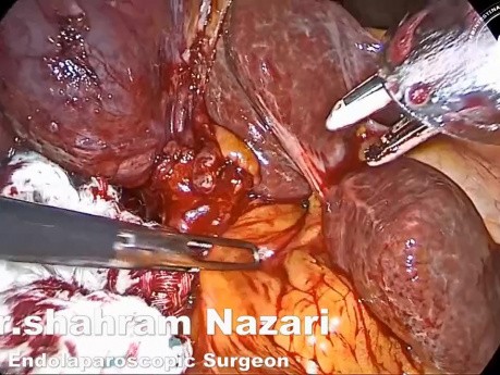 LCBDE after failed ERCP Stone Extraction Railway Technique