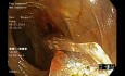 Balloon Dilatation of Stenosis