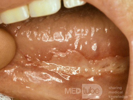 Giant Apthous Ulcer