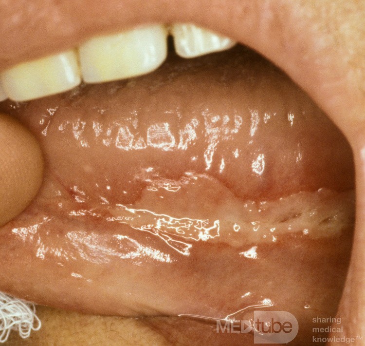 Giant Apthous Ulcer