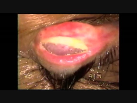 Entropion of Half of the Upper Lid Surgery for Correction