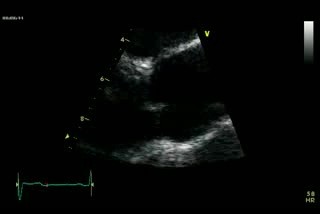 Biscupid Aortic Valve