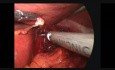 Laparoscopic Truncal Vagotomy and GJ
