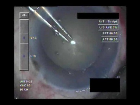 Cataract Surgery - Part 1