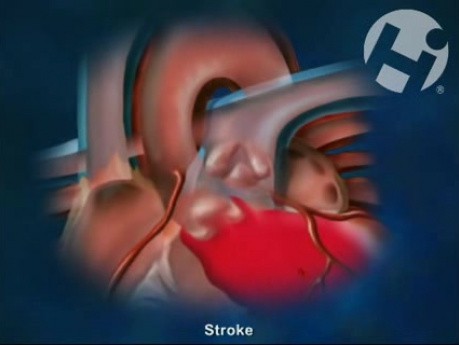 Stroke and TIA