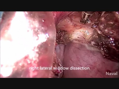 Difficult vNOTES Hysterectomy for Previous Two Cesarean Scarred Large Fibroid Uterus