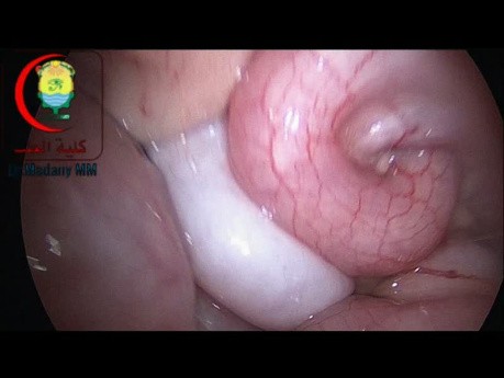 Is it an Amyand's Hernia or Not