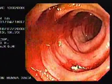 Diverticular Bleeding (2 of 4)