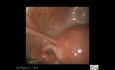 Normal Uterus Anatomical  Structure 