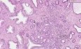 Prostate - Adenocarcinoma (Gleason grade 2) - Histopathology