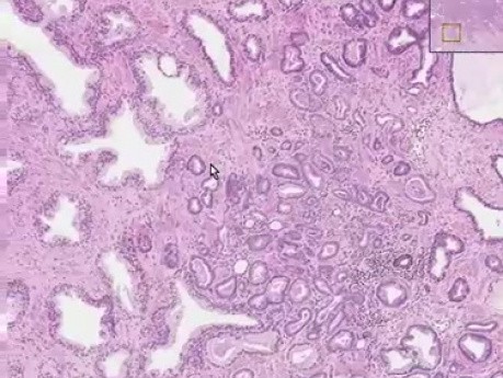 Prostate - Adenocarcinoma (Gleason grade 2) - Histopathology