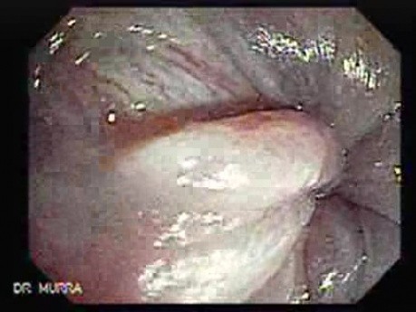 Anal Fissure (2 of 2)